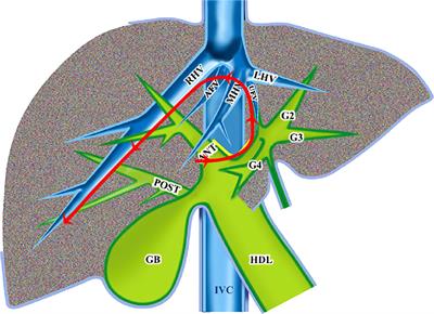 Counterclockwise modular laparoscopic anatomical mesohepatectomy using combined glissonean pedicle (Takasaki approach) and hepatic vein-guided approaches